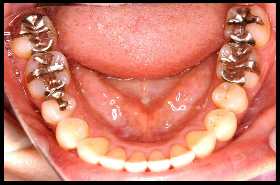 審美歯科の症例4