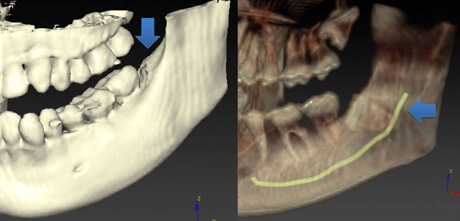 CTによる智歯診断