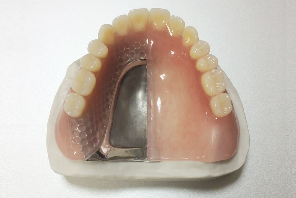 トルティッシュ義歯