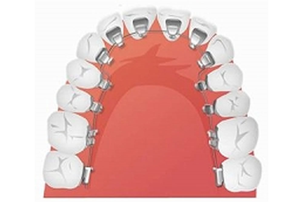 裏側矯正（舌側矯正）