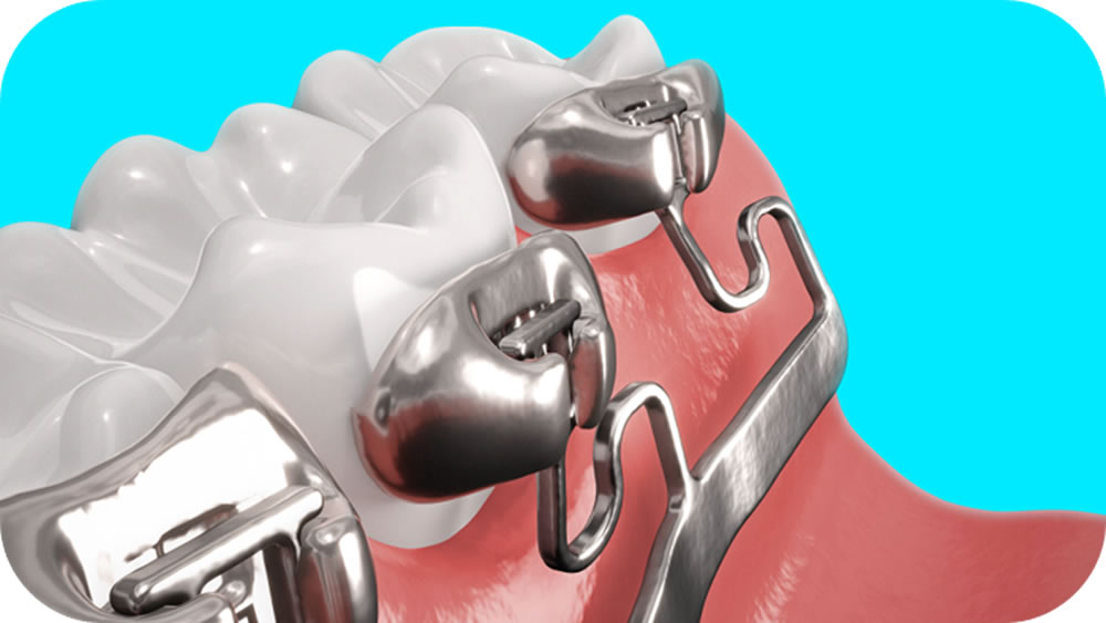 裏側矯正Brava（ブラーバ）とは？