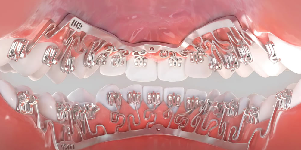 裏側矯正Brava（ブラーバ）とは？