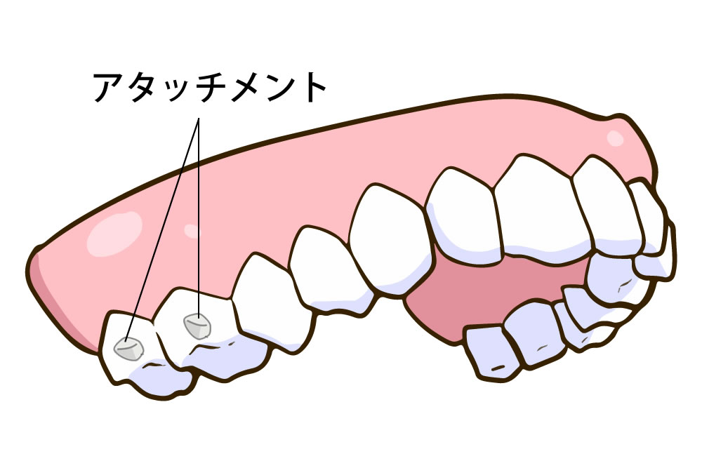 歯にアタッチメントを接着
