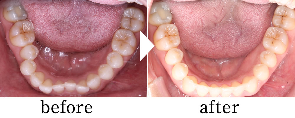 マウスピース矯正治療の症例